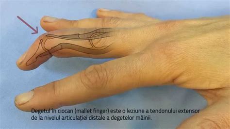 ameliorează durerea în articulațiile degetelor